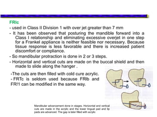 FRlc
- used in Class II Division 1 with over jet greater than 7 mm
- It has been observed that posturing the mandible forward into a
Class I relationship and eliminating excessive overjet in one step
for a Frankel appliance is neither feasible nor necessary. Because
tissue response is less favorable and there is increased patient
discomfort or compliance.
- So mandibular protraction is done in 2 or 3 steps.
- Horizontal and vertical cuts are made on the buccal shield and then
made to slide along the hanger .
-The cuts are then filled with cold cure acrylic.
- FRTc is seldom used because FRlb and
FR!1 can be modified in the same way.
Mandibular advancement done in stages. Horizontal and vertical
cuts are made in the acrylic and the lower lingual pad and lip
pads are advanced. The gap is later filled with acrylic
 