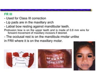 FR III
- Used for Class III correction
- Lip pads are in the maxillary arch
- Labial bow resting against mandibular teeth.
Protrusion bow is on the upper teeth and is made of 0.8 mm wire for
forward movement of maxillary incisiors if desired.
- The occlusal rest is on the mandibula rmolar unlike
in FRII where it is on the maxillary molar.
 
