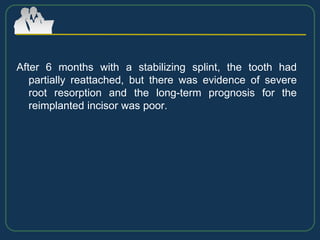After 6 months with a stabilizing splint, the tooth had
partially reattached, but there was evidence of severe
root resorption and the long-term prognosis for the
reimplanted incisor was poor.
 