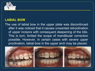 LABIAL BOW
The use of labial bow in the upper plate was discontinued
after it was noticed that it causes unwanted retroclination
of upper incisors with consequent deepening of the bite.
This is turn, limited the scope of mandibular correction
possible. However, in certain cases with severe upper
proclination, labial bow in the upper arch may be placed.
 