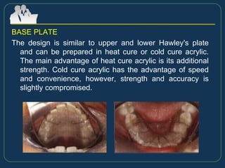 BASE PLATE
The design is similar to upper and lower Hawley's plate
and can be prepared in heat cure or cold cure acrylic.
The main advantage of heat cure acrylic is its additional
strength. Cold cure acrylic has the advantage of speed
and convenience, however, strength and accuracy is
slightly compromised.
 