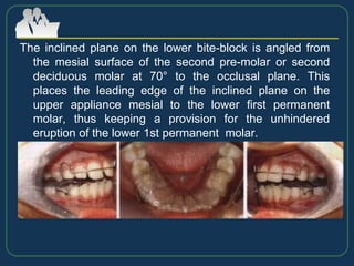 The inclined plane on the lower bite-block is angled from
the mesial surface of the second pre-molar or second
deciduous molar at 70° to the occlusal plane. This
places the leading edge of the inclined plane on the
upper appliance mesial to the lower first permanent
molar, thus keeping a provision for the unhindered
eruption of the lower 1st permanent molar.
 