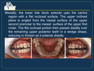 Mesially, the lower bite block extends upto the canine
region with a flat occlusal surface. The upper inclined
plane is angled from the mesial surface of the upper
second premolar to the mesial surface of the upper first
molar. The flat occlusal portion then passes distally over
the remaining upper posterior teeth in a wedge shape,
reducing m thicken as it extends distally.
 