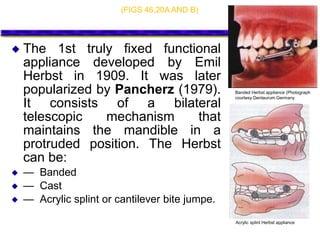  The 1st truly fixed functional
appliance developed by Emil
Herbst in 1909. It was later
popularized by Pancherz (1979).
It consists of a bilateral
telescopic mechanism that
maintains the mandible in a
protruded position. The Herbst
can be:
 — Banded
 — Cast
 — Acrylic splint or cantilever bite jumpe.
(FIGS 46,20A AND B)
Banded Herbst appliance (Photograph
courtesy Dentaurum.Germany
Acrylic splint Herbst appliance
 