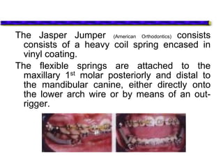 The Jasper Jumper (American Orthodontics) consists
consists of a heavy coil spring encased in
vinyl coating.
The flexible springs are attached to the
maxillary 1st molar posteriorly and distal to
the mandibular canine, either directly onto
the lower arch wire or by means of an out-
rigger.
 