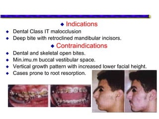  Indications
 Dental Class IT malocclusion
 Deep bite with retroclined mandibular incisors.
 Contraindications
 Dental and skeletal open bites.
 Min.imu.m buccal vestibular space.
 Vertical growth pattern with increased lower facial height.
 Cases prone to root resorption.
 