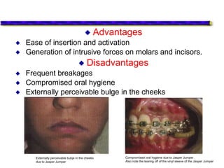  Advantages
 Ease of insertion and activation
 Generation of intrusive forces on molars and incisors.
 Disadvantages
 Frequent breakages
 Compromised oral hygiene
 Externally perceivable bulge in the cheeks
Compromised oral hygiene due to Jasper Jumper.
Also note the tearing off of the vinyl sleeve of the Jasper Jumper
Externally perceivable bulqe in the cheeks
due to Jasper Jumper
 