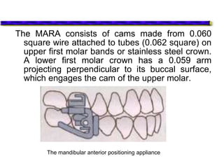 The MARA consists of cams made from 0.060
square wire attached to tubes (0.062 square) on
upper first molar bands or stainless steel crown.
A lower first molar crown has a 0.059 arm
projecting perpendicular to its buccal surface,
which engages the cam of the upper molar.
The mandibular anterior positioning appliance
 