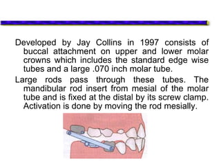 Developed by Jay Collins in 1997 consists of
buccal attachment on upper and lower molar
crowns which includes the standard edge wise
tubes and a large .070 inch molar tube.
Large rods pass through these tubes. The
mandibular rod insert from mesial of the molar
tube and is fixed at the distal by its screw clamp.
Activation is done by moving the rod mesially.
 
