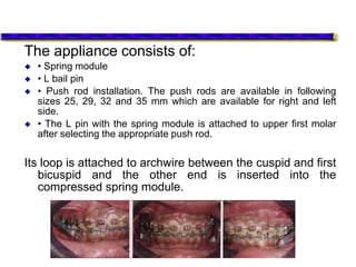 The appliance consists of:
 • Spring module
 • L bail pin
 • Push rod installation. The push rods are available in following
sizes 25, 29, 32 and 35 mm which are available for right and left
side.
 • The L pin with the spring module is attached to upper first molar
after selecting the appropriate push rod.
Its loop is attached to archwire between the cuspid and first
bicuspid and the other end is inserted into the
compressed spring module.
 