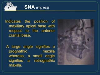 Indicates the position of
maxillary apical base with
respect to the anterior
cranial base.
A large angle signifies a
prognathic maxilla
whereas, a small angle
signifies a retrognathic
maxilla.
SNA (Fig. 46.6)
 