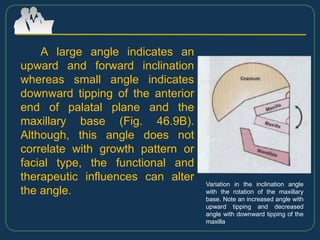 A large angle indicates an
upward and forward inclination
whereas small angle indicates
downward tipping of the anterior
end of palatal plane and the
maxillary base (Fig. 46.9B).
Although, this angle does not
correlate with growth pattern or
facial type, the functional and
therapeutic influences can alter
the angle.
Variation in the inclination angle
with the rotation of the maxillary
base. Note an increased angle with
upward tipping and decreased
angle with downward tipping of the
maxilla
 