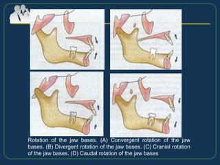Rotation of the jaw bases. (A) Convergent rotation of the jaw
bases. (B) Divergent rotation of the jaw bases. (C) Cranial rotation
of the jaw bases. (D) Caudal rotation of the jaw bases
 