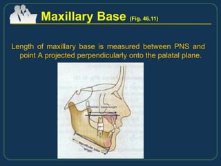 Length of maxillary base is measured between PNS and
point A projected perpendicularly onto the palatal plane.
Maxillary Base (Fig. 46.11)
 