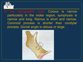In the retrognathic type- Corpus is narrow
particularly in the molar region, symphysis is
narrow and long. Ramus is short and narrow.
Coronoid process is shorter than condylar
process. Gonial angle is obtuse or large.
 