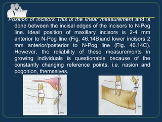 Position of incisors This is the linear measurement and is
done between the incisal edges of the incisors to N-Pog
line. ldeal position of maxillary incisors is 2-4 mm
anterior to N-Pog line (Fig. 46.14B)and lower incisors 2
mm anterior/posterior to N-Pog line (Fig. 46.14C).
However, the reliability of these measurements in
growing individuals is questionable because of the
constantly changing reference points, i.e. nasion and
pogonion, themselves.
 
