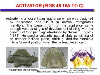 ACTIVATOR (FIGS 46.15A TO C)
Activator is a loose fitting appliance which was designed
by Andreasen and Haupl to correct retrognathic
mandible. The present form of the appliance came
through various stages of development starting with the
concept of 'bite jumping' introduced by Norman Kingsley
(1879). He used a vulcanite palatal plate consisting of
an anterior inclined plane, which guided the mandible
into a forward position when the patient closed on it.
The activator (frontal view)
The activator (superior view)
The activator(lingualview) showingthe
jack screw (Photograph courtesy:
Dentaurum Germany
 