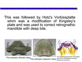 This was followed by Hotz's Vorbissplatte
whim was a modification of Kingsley's
plate and was used to correct retrognathic
mandible with deep bite.
The activator (frontal view)
The activator (superior view)
The activator(lingualview) showingthe
jack screw (Photograph courtesy:
Dentaurum Germany
 