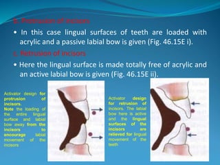 b. Protrusion of incisors
• In this case lingual surfaces of teeth are loaded with
acrylic and a passive labial bow is given (Fig. 46.15E i).
c. Retrusion of incisors
• Here the lingual surface is made totally free of acrylic and
an active labial bow is given (Fig. 46.15E ii).
91
Activator design for
protrusion of
incisors.
Note the loading of
the entire lingual
surface and labial
bow away from the
incisors to
encourage labial
movement of the
incisors
Activator design
for retrusion of
incisors. The labial
bow here is active
and the lingual
surfaces of the
incisors are
relieved for lingual
movement of the
teeth
 