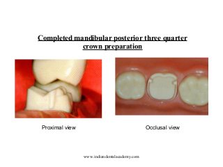 Completed mandibular posterior three quarter
crown preparation

Proximal view

Occlusal view

www.indiandentalacademy.com

 
