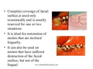 • Complete coverage of facial
surface,is used only
ocassionally and is usually
reserved for one or two
situations
• It is ideal for restoration of
molars that are inclined
lingually.
• It can also be used on
molars that have suffered
destruction of the facial
surface, but not of the
www.indiandentalacademy.com
lingual

 