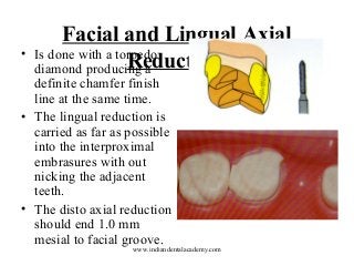 •

Facial and Lingual Axial
Is done with a torpedo
Reduction
diamond producing a

definite chamfer finish
line at the same time.
• The lingual reduction is
carried as far as possible
into the interproximal
embrasures with out
nicking the adjacent
teeth.
• The disto axial reduction
should end 1.0 mm
mesial to facial groove.

www.indiandentalacademy.com

 