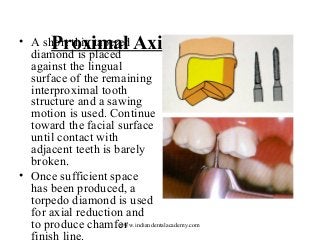 • A short thin tapered Axial Reduction
Proximal
diamond is placed
against the lingual
surface of the remaining
interproximal tooth
structure and a sawing
motion is used. Continue
toward the facial surface
until contact with
adjacent teeth is barely
broken.
• Once sufficient space
has been produced, a
torpedo diamond is used
for axial reduction and
www.indiandentalacademy.com
to produce chamfer
finish line.

 