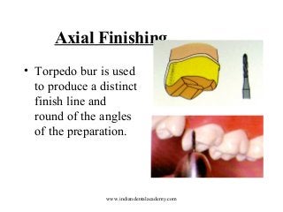 Axial Finishing
• Torpedo bur is used
to produce a distinct
finish line and
round of the angles
of the preparation.

www.indiandentalacademy.com

 
