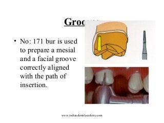 Grooves
• No: 171 bur is used
to prepare a mesial
and a facial groove
correctly aligned
with the path of
insertion.

www.indiandentalacademy.com

 