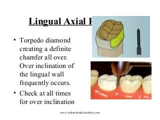 Lingual Axial Reduction
• Torpedo diamond
creating a definite
chamfer all over.
Over inclination of
the lingual wall
frequently occurs.
• Check at all times
for over inclination
www.indiandentalacademy.com

 