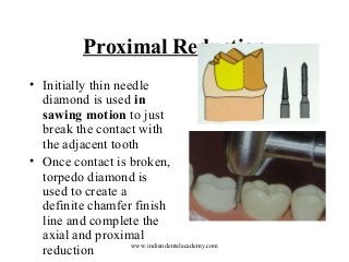 Proximal Reduction
• Initially thin needle
diamond is used in
sawing motion to just
break the contact with
the adjacent tooth
• Once contact is broken,
torpedo diamond is
used to create a
definite chamfer finish
line and complete the
axial and proximal
www.indiandentalacademy.com
reduction

 