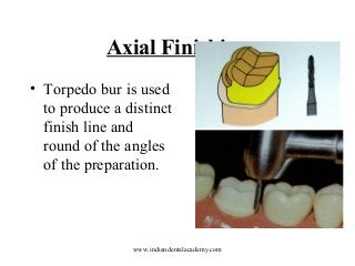 Axial Finishing
• Torpedo bur is used
to produce a distinct
finish line and
round of the angles
of the preparation.

www.indiandentalacademy.com

 