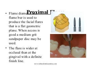 Proximal
• Flame diamond and
flame bur is used to
produce the facial flares
that is a flat geometric
plane. When access is
good a medium grit
sandpaper disc may be
used.
• The flare is wider at
occlusal than at the
gingival with a definite
finish line.

Flares

www.indiandentalacademy.com

 