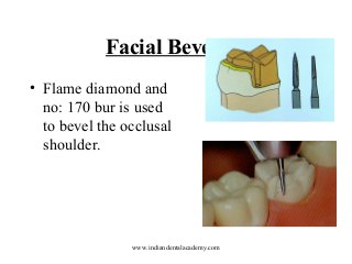 Facial Bevel
• Flame diamond and
no: 170 bur is used
to bevel the occlusal
shoulder.

www.indiandentalacademy.com

 