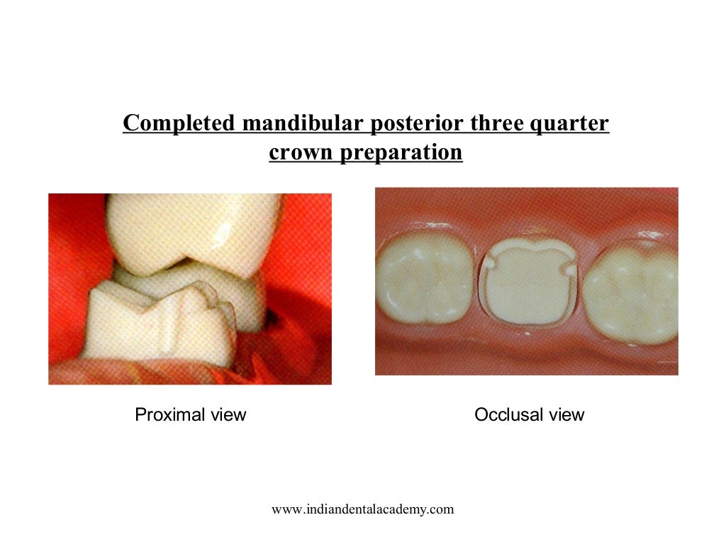 Functional cusp /certified fixed orthodontic courses by Indian dental…