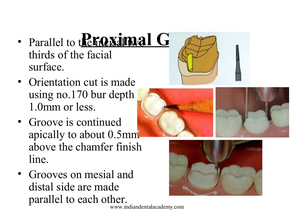 Functional cusp /certified fixed orthodontic courses by Indian dental…