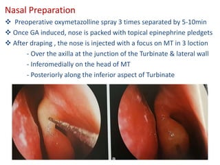 Nasal Preparation
 Preoperative oxymetazolline spray 3 times separated by 5-10min
 Once GA induced, nose is packed with topical epinephrine pledgets
 After draping , the nose is injected with a focus on MT in 3 loction
- Over the axilla at the junction of the Turbinate & lateral wall
- Inferomedially on the head of MT
- Posteriorly along the inferior aspect of Turbinate
 