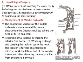 A. Nasal Septal Surgery
If a DNS is present, obstructing the nasal cavity
& limiting the nasal airway or access to the
sinus cavities , a septoplsty is performed prior
to beginning the sinus surgery
B. Management of Middle Turbinate
 The anatomical variants of the middle
turbinate may cause middle meatal
obstruction like Choncha Bullosa where the
head of MT is enlarged.
 Resection of CB is done by incising the
inferior free border of MT along its length
and carrying the incision up to the neck.
The incision is further enlarged using
microscisor & the lateral half of the concha
is removed after elevating the mucosal flap
from the lateral bony wall
 