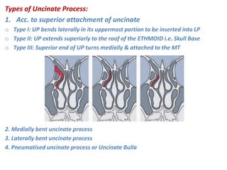 Types of Uncinate Process:
1. Acc. to superior attachment of uncinate
o Type I: UP bends laterally in its uppermost portion to be inserted into LP
o Type II: UP extends superiorly to the roof of the ETHMOID i.e. Skull Base
o Type III: Superior end of UP turns medially & attached to the MT
2. Medially bent uncinate process
3. Laterally bent uncinate process
4. Pneumatised uncinate process or Uncinate Bulla
 
