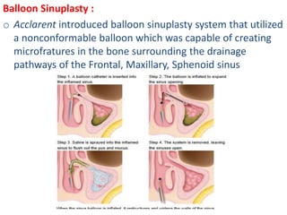 Balloon Sinuplasty :
o Acclarent introduced balloon sinuplasty system that utilized
a nonconformable balloon which was capable of creating
microfratures in the bone surrounding the drainage
pathways of the Frontal, Maxillary, Sphenoid sinus
 