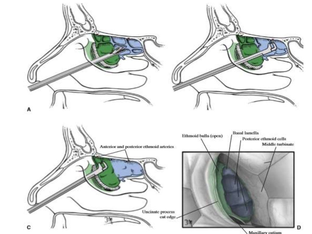 Functional endoscopic sinus surgery