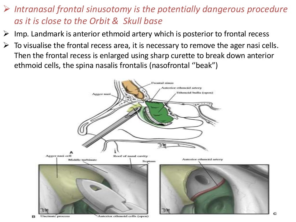 Functional endoscopic sinus surgery