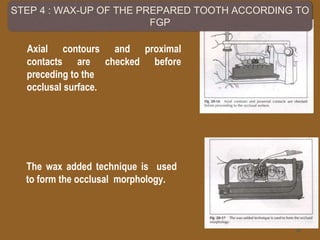 Axial contours and proximal
contacts are checked before
preceding to the
occlusal surface.
15
The wax added technique is used
to form the occlusal morphology.
STEP 4 : WAX-UP OF THE PREPARED TOOTH ACCORDING TO
FGP
 