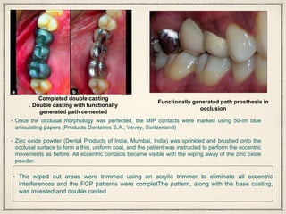 Completed double casting
. Double casting with functionally
generated path cemented
Functionally generated path prosthesis in
occlusion
• Once the occlusal morphology was perfected, the MIP contacts were marked using 50-ìm blue
articulating papers (Products Dentaires S.A., Vevey, Switzerland)
• Zinc oxide powder (Dental Products of India, Mumbai, India) was sprinkled and brushed onto the
occlusal surface to form a thin, uniform coat, and the patient was instructed to perform the eccentric
movements as before. All eccentric contacts became visible with the wiping away of the zinc oxide
powder.
• The wiped out areas were trimmed using an acrylic trimmer to eliminate all eccentric
interferences and the FGP patterns were completThe pattern, along with the base casting,
was invested and double casted
 