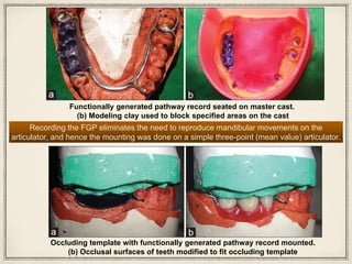 Functionally generated pathway record seated on master cast.
(b) Modeling clay used to block specified areas on the cast
Recording the FGP eliminates the need to reproduce mandibular movements on the
articulator, and hence the mounting was done on a simple three-point (mean value) articulator.
Occluding template with functionally generated pathway record mounted.
(b) Occlusal surfaces of teeth modified to fit occluding template
 
