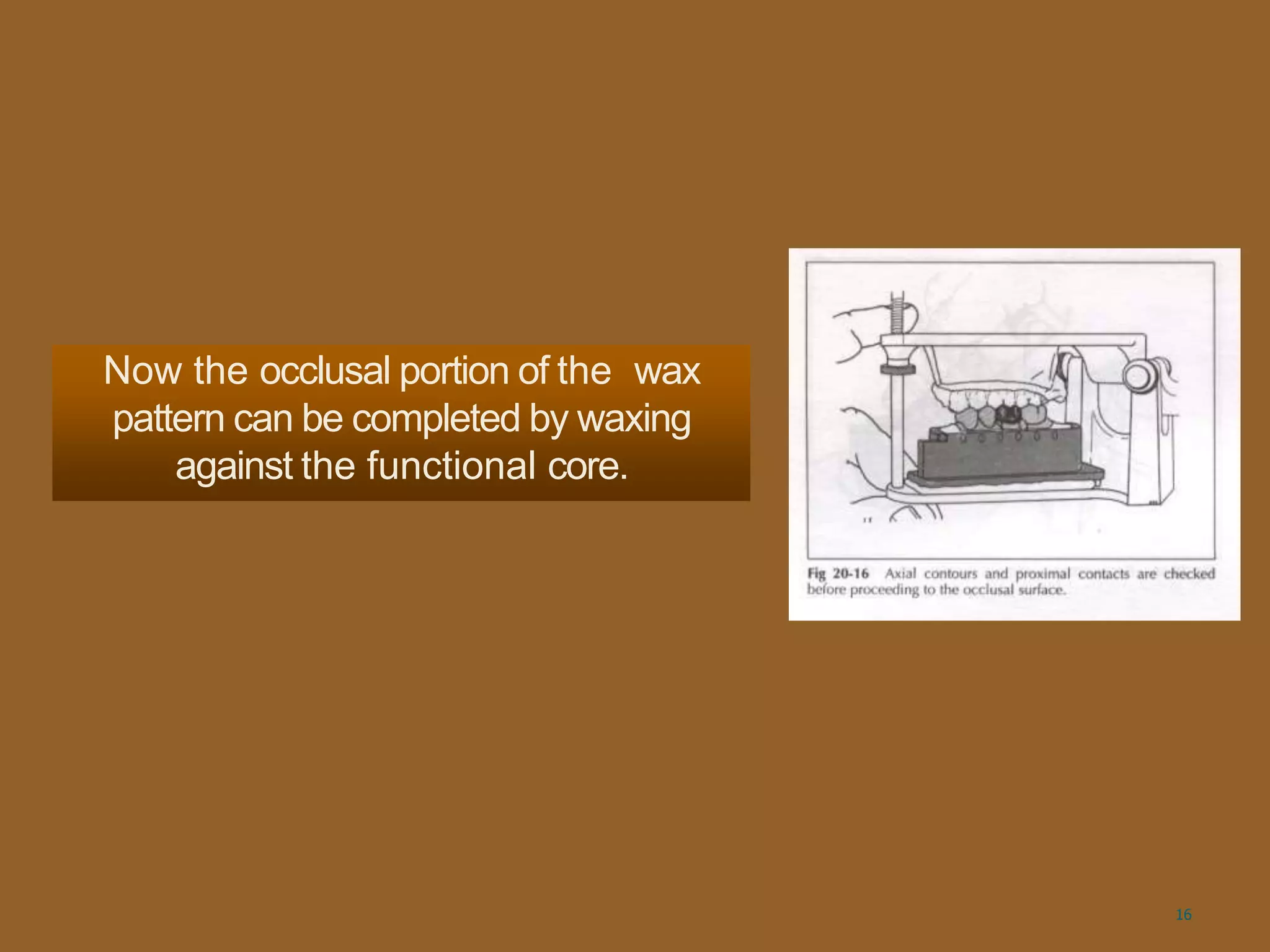 Now the occlusal portion of the wax
pattern can be completed by waxing
against the functional core.
16
 