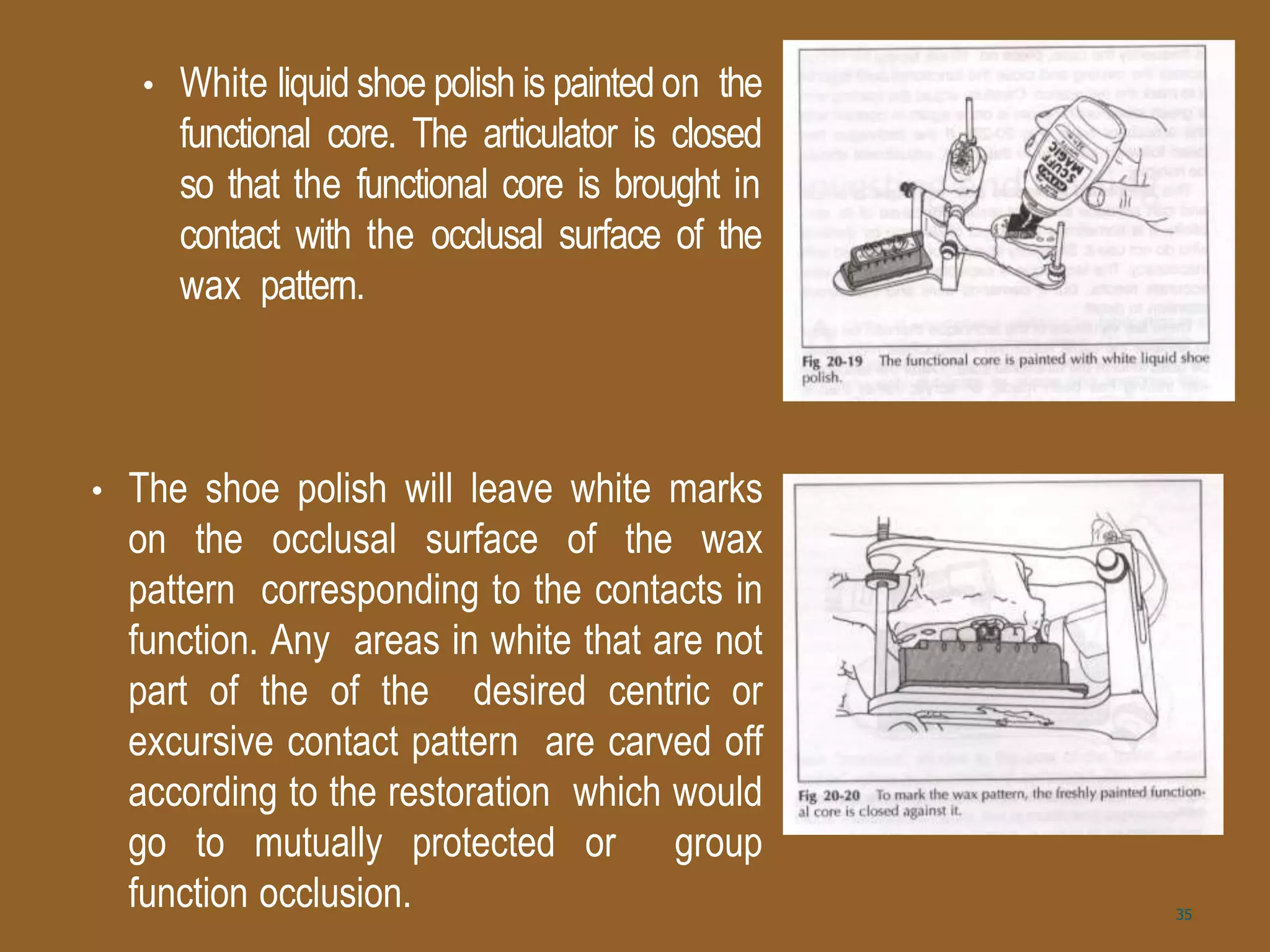 • White liquid shoe polish is painted on the
functional core. The articulator is closed
so that the functional core is brought in
contact with the occlusal surface of the
wax pattern.
• The shoe polish will leave white marks
on the occlusal surface of the wax
pattern corresponding to the contacts in
function. Any areas in white that are not
part of the of the desired centric or
excursive contact pattern are carved off
according to the restoration which would
go to mutually protected or group
function occlusion. 35
 