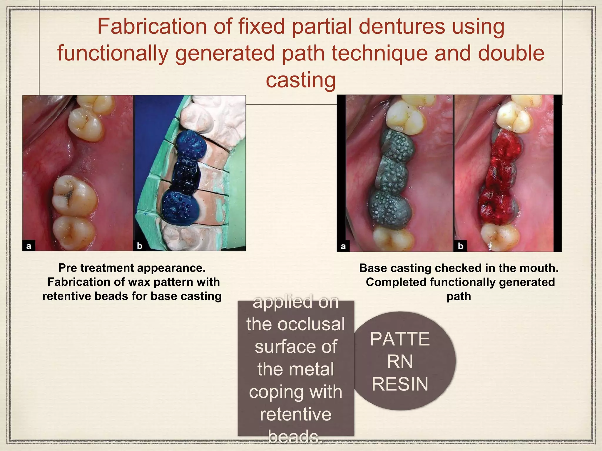 Fabrication of fixed partial dentures using
functionally generated path technique and double
casting
Pre treatment appearance.
Fabrication of wax pattern with
retentive beads for base casting
Base casting checked in the mouth.
Completed functionally generated
path
PATTE
RN
RESIN
applied on
the occlusal
surface of
the metal
coping with
retentive
beads.
 