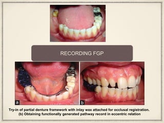 Try-in of partial denture framework with inlay wax attached for occlusal registration.
(b) Obtaining functionally generated pathway record in eccentric relation
RECORDING FGP
 