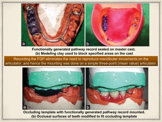 Functionally generated pathway record seated on master cast.
(b) Modeling clay used to block specified areas on the cast
Recording the FGP eliminates the need to reproduce mandibular movements on the
articulator, and hence the mounting was done on a simple three-point (mean value) articulator.
Occluding template with functionally generated pathway record mounted.
(b) Occlusal surfaces of teeth modified to fit occluding template
 